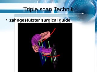Triple scan Technik
• zahngestützter surgical guide
 