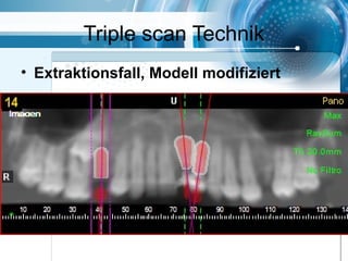 Triple scan Technik
• Extraktionsfall, Modell modifiziert
 