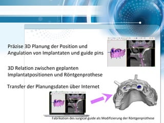 Transfer der Planungsdaten über Internet
Präzise 3D Planung der Position und
Angulation von Implantaten und guide pins
3D Relation zwischen geplanten
Implantatpositionen und Röntgenprothese
Fabrikation des surgical guide als Modifizierung der Röntgenprothese
 