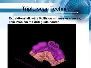 Triple scan Technik
• Extraktionsfall, wäre Kollision mit master sleeves,
kein Problem mit drill guide handle
 