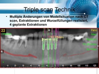 Triple scan Technik
• Multiple Änderungen von Modellsituation nach CT
scan, Extraktionen und Wurzelfüllungen realisiert,
4 geplante Extraktionen
 