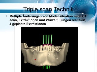 Triple scan Technik
• Multiple Änderungen von Modellsituation nach CT
scan, Extraktionen und Wurzelfüllungen realisiert,
4 geplante Extraktionen
 