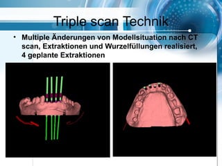 Triple scan Technik
• Multiple Änderungen von Modellsituation nach CT
scan, Extraktionen und Wurzelfüllungen realisiert,
4 geplante Extraktionen
 