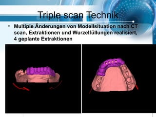 Triple scan Technik
• Multiple Änderungen von Modellsituation nach CT
scan, Extraktionen und Wurzelfüllungen realisiert,
4 geplante Extraktionen
 