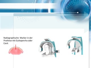 Radiographische Marker in der
Prothese mit Guttapercha oder
Cavit
 