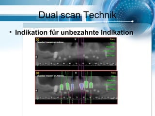 Dual scan Technik
• Indikation für unbezahnte Indikation
 