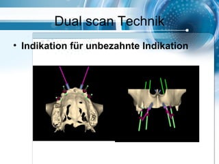 Dual scan Technik
• Indikation für unbezahnte Indikation
 