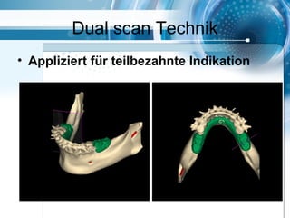 Dual scan Technik
• Appliziert für teilbezahnte Indikation
 