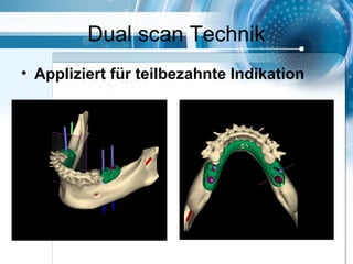 Dual scan Technik
• Appliziert für teilbezahnte Indikation
 