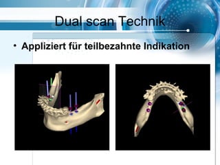Dual scan Technik
• Appliziert für teilbezahnte Indikation
 