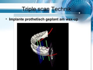 Triple scan Technik
• Implante prothetisch geplant am wax-up
 