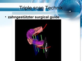Triple scan Technik
• zahngestützter surgical guide
 
