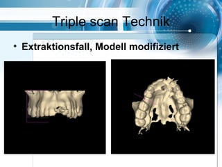 Triple scan Technik
• Extraktionsfall, Modell modifiziert
 