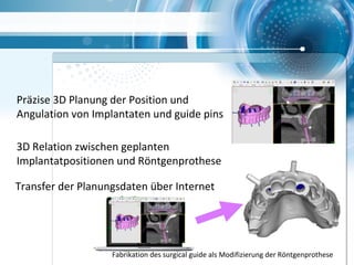 Transfer der Planungsdaten über Internet
Präzise 3D Planung der Position und
Angulation von Implantaten und guide pins
3D Relation zwischen geplanten
Implantatpositionen und Röntgenprothese
Fabrikation des surgical guide als Modifizierung der Röntgenprothese
 