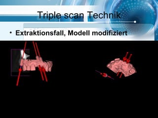 Triple scan Technik
• Extraktionsfall, Modell modifiziert
 