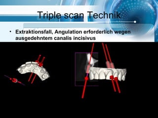 Triple scan Technik
• Extraktionsfall, Angulation erforderlich wegen
ausgedehntem canalis incisivus
 