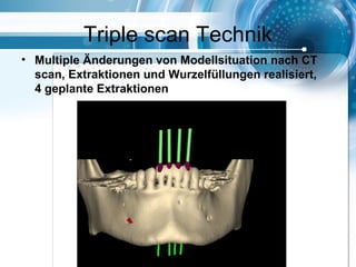 Triple scan Technik
• Multiple Änderungen von Modellsituation nach CT
scan, Extraktionen und Wurzelfüllungen realisiert,
4 geplante Extraktionen
 