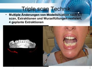 Triple scan Technik
• Multiple Änderungen von Modellsituation nach CT
scan, Extraktionen und Wurzelfüllungen realisiert,
4 geplante Extraktionen
 