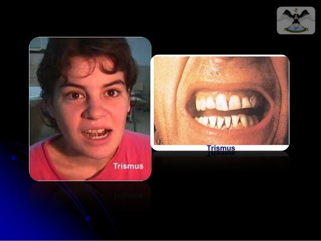 Trismus Trismus