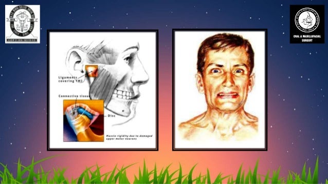 differential diagnosis of trismus trismus