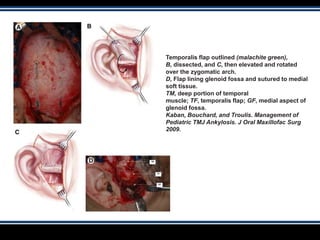 Temporalis flap outlined (malachite green),
B, dissected, and C, then elevated and rotated
over the zygomatic arch.
D, Flap lining glenoid fossa and sutured to medial
soft tissue.
TM, deep portion of temporal
muscle; TF, temporalis flap; GF, medial aspect of
glenoid fossa.
Kaban, Bouchard, and Troulis. Management of
Pediatric TMJ Ankylosis. J Oral Maxillofac Surg
2009.
 