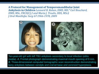 A Protocol for Management of Temporomandibular Joint
Ankylosis in Children Leonard B. Kaban, DMD, MD,* Carl Bouchard,
DMD, MSc, FRCD(C),† and Maria J. Troulis, DDS, MSc‡
J Oral Maxillofac Surg 67:1966-1978, 2009
Ten-year-old girl with left TMJ ankylosis secondary to local infection (otitis
media). A, Frontal photograph demonstrating maximal mouth opening of 0 mm.
B, Three-dimensional computed tomographic scan reconstruction demonstrating
bony ankylosis between condyle and cranial base and coronoid hyperplasia.
 