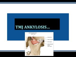 TMJ ANKYLOSIS…
 