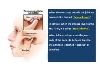 When the structures outside the joint are
involved, it is termed "false ankylosis”.
in contrast when the disease involves the
TMJ itself, it is called "true ankylosis”.
When inflammation causes the joint-
ends of the bones to be fused together
the ankylosis is termed “ osseous” or
complete
 