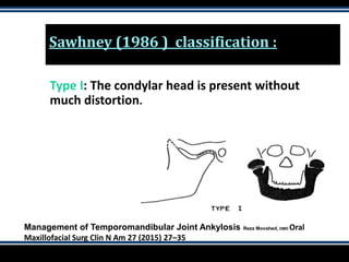 Sawhney (1986 ) classification :
Type I: The condylar head is present without
much distortion.
Management of Temporomandibular Joint Ankylosis Reza Movahed, DMD Oral
Maxillofacial Surg Clin N Am 27 (2015) 27–35
 