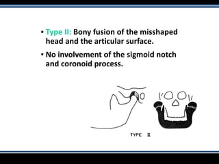 ▪ Type II: Bony fusion of the misshaped
head and the articular surface.
▪ No involvement of the sigmoid notch
and coronoid process.
 