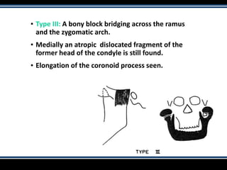 ▪ Type III: A bony block bridging across the ramus
and the zygomatic arch.
▪ Medially an atropic dislocated fragment of the
former head of the condyle is still found.
▪ Elongation of the coronoid process seen.
 