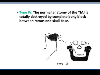 ▪ Type IV: The normal anatomy of the TMJ is
totally destroyed by complete bony block
between ramus and skull base.
 