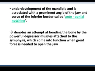 ▪ underdevelopment of the mandible and is
associated with a prominent angle of the jaw and
curve of the inferior border called ‘ante - gonial
notching’.
 denotes an attempt at bending the bone by the
powerful depressor muscles attached to the
symphysis, which come into function when great
force is needed to open the jaw
 