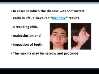 ▪ In cases in which the disease was contracted
early in life, a so-called “bird face‟ results.
- a receding chin,
- malocclusion and
- impaction of teeth.
▪ The maxilla may be narrow and protrude
 