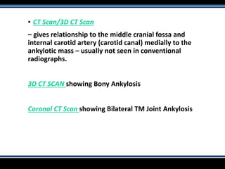 ▪ CT Scan/3D CT Scan
– gives relationship to the middle cranial fossa and
internal carotid artery (carotid canal) medially to the
ankylotic mass – usually not seen in conventional
radiographs.
3D CT SCAN showing Bony Ankylosis
Coronal CT Scan showing Bilateral TM Joint Ankylosis
 