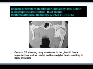 Imaging of temporomandibular joint ankylosis. A new
radiographic classification- IE El-Hakim
Dentomaxillofacial Radiology (2002) 31, 19 ± 23
Coronal CT showing bony exostoses in the glenoid fossa
superiorly as well as medial on the condylar head, resulting in
bony ankylosis
 