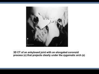 3D CT of an ankylosed joint with an elongated coronoid
process (c) that projects clearly under the zygomatic arch (z)
 