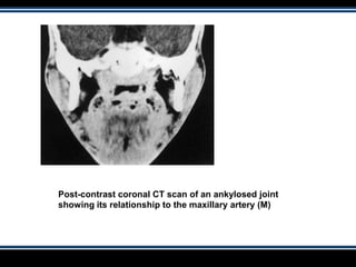 Post-contrast coronal CT scan of an ankylosed joint
showing its relationship to the maxillary artery (M)
 