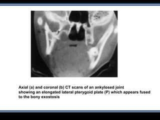 Axial (a) and coronal (b) CT scans of an ankylosed joint
showing an elongated lateral pterygoid plate (P) which appears fused
to the bony exostosis
 