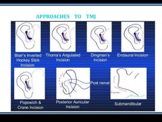 APPROACHES TO TMJ
 