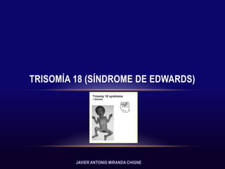 TRISOMÍA 18 (SÍNDROME DE EDWARDS)




         JAVIER ANTONIO MIRANDA CHIGNE
 