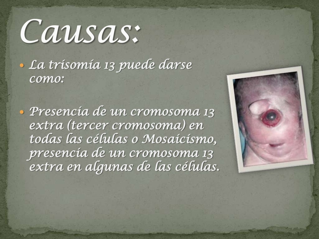 Trisomía del cromosoma 13