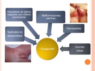 *Urogenital*
Testículos no
descendidos
Hipoplasia de labios
mayores con clítoris
prominente
Malformaciones
uterinas
Hipospadias
Escroto
bífido
 
