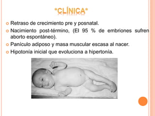  Retraso de crecimiento pre y posnatal.
 Nacimiento post-término, (El 95 % de embriones sufren
aborto espontáneo).
 Panículo adiposo y masa muscular escasa al nacer.
 Hipotonía inicial que evoluciona a hipertonía.
 