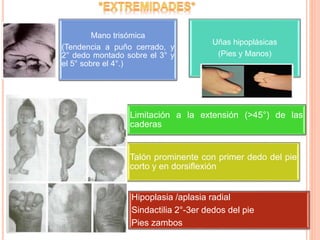 Mano trisómica
(Tendencia a puño cerrado, y
2° dedo montado sobre el 3° y
el 5° sobre el 4°.)
Uñas hipoplásicas
(Pies y Manos)
Limitación a la extensión (>45°) de las
caderas
Talón prominente con primer dedo del pie
corto y en dorsiflexión
Hipoplasia /aplasia radial
Sindactilia 2°-3er dedos del pie
Pies zambos
 