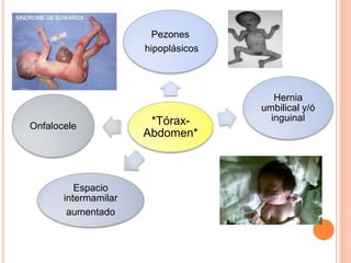*Tórax-
Abdomen*
Pezones
hipoplásicos
Hernia
umbilical y/ó
inguinal
Espacio
intermamilar
aumentado
Onfalocele
 