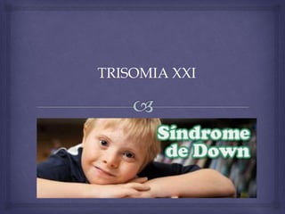 TRISOMIA XXI
 