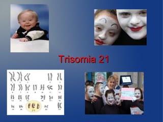 Trisomia 21Trisomia 21
 