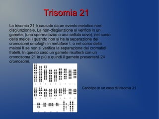 La trisomia 21 è causato da un evento meiotico non-
disgiunzionale. La non-disgiunzione si verifica in un
gamete, (uno spermatozoo o una cellula uovo), nel corso
della meiosi I quando non si ha la separazione dei
cromosomi omologhi in metafase I, o nel corso della
meiosi II se non si verifica la separazione dei cromatidi
fratelli. In questo caso un gamete risulterà con un
cromosoma 21 in più e quindi il gamete presenterà 24
cromosomi.
Cariotipo in un caso di trisomia 21
Trisomia 21Trisomia 21
 