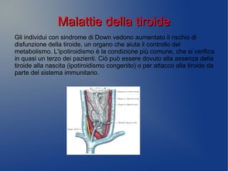 Malattie della tiroideMalattie della tiroide
Gli individui con sindrome di Down vedono aumentato il rischio di
disfunzione della tiroide, un organo che aiuta il controllo del
metabolismo. L'ipotiroidismo è la condizione più comune, che si verifica
in quasi un terzo dei pazienti. Ciò può essere dovuto alla assenza della
tiroide alla nascita (ipotiroidismo congenito) o per attacco alla tiroide da
parte del sistema immunitario.
 
